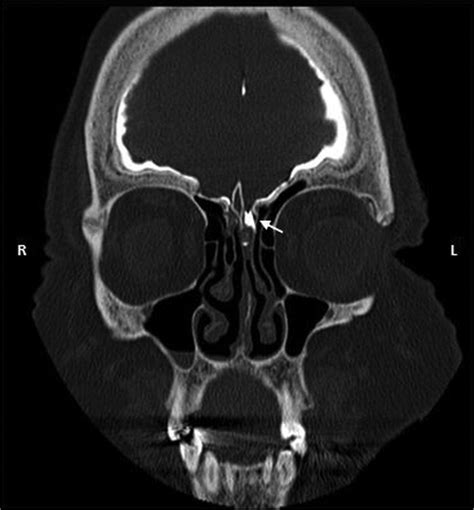 Search Page 1/1: rhinorrhea